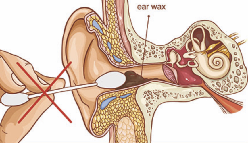 No to cotton wool buds when removing ear wax